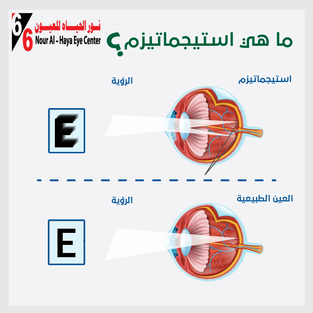 الاستيجماتيزم.jpg