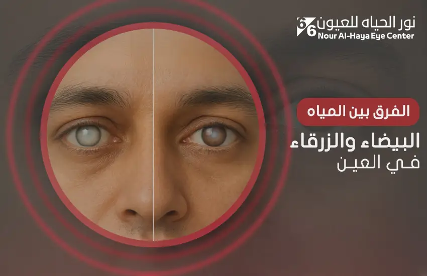 الفرق بين المياه البيضاء والزرقاء في العين
