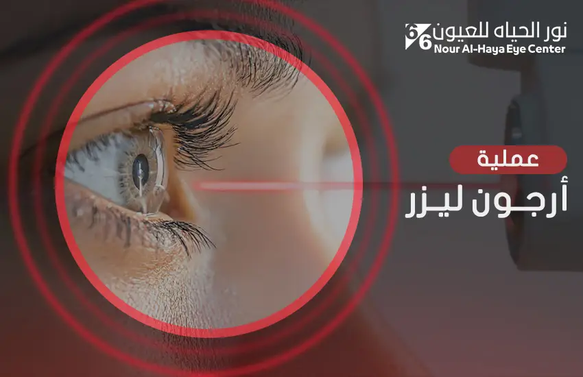 عملية أرجون ليزر