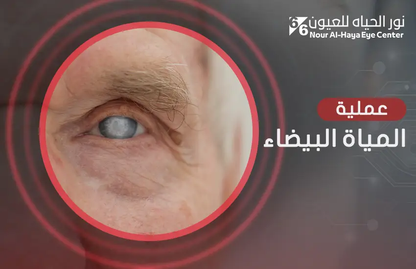 عملية المياه البيضاء 