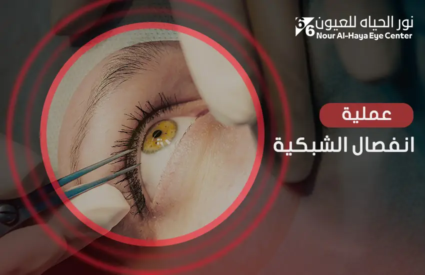 عملية انفصال الشبكية