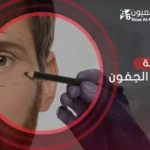 عملية تجميل الجفون