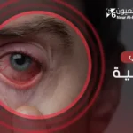 ما هو التهاب القرنية؟ وما علاجه؟
